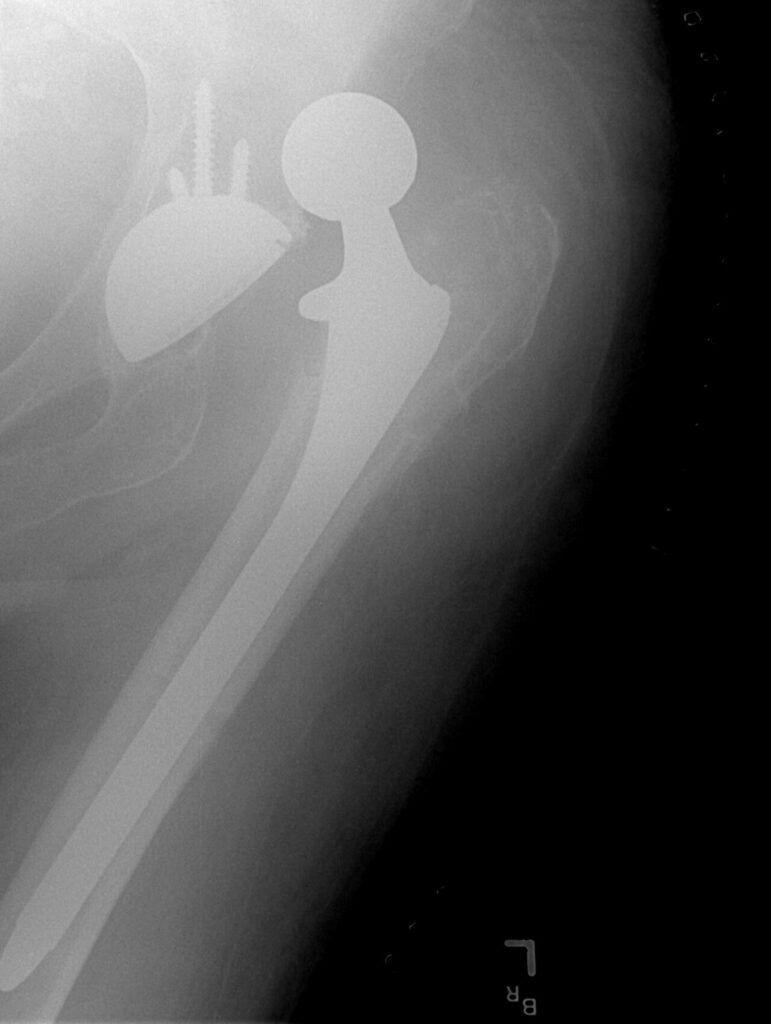 Dislocation of Total Hip Replacements, radiograph of a dislocated total hip arthroplasty