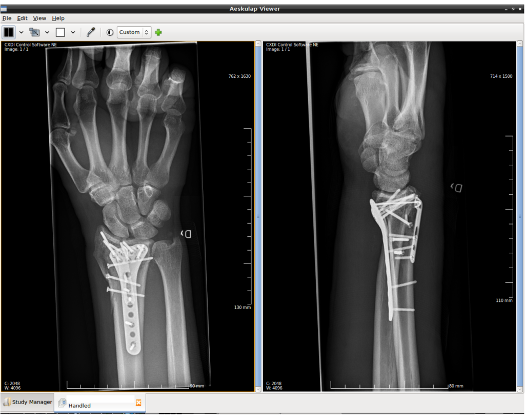 Distal Radius Fixation, radiographs of a distal radius fracture fixed with a volar plate