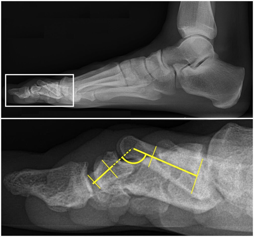 Dorsal MTPJ Lesser Toes, lateral radiograph showing measurement of toe interphalangeal flexion