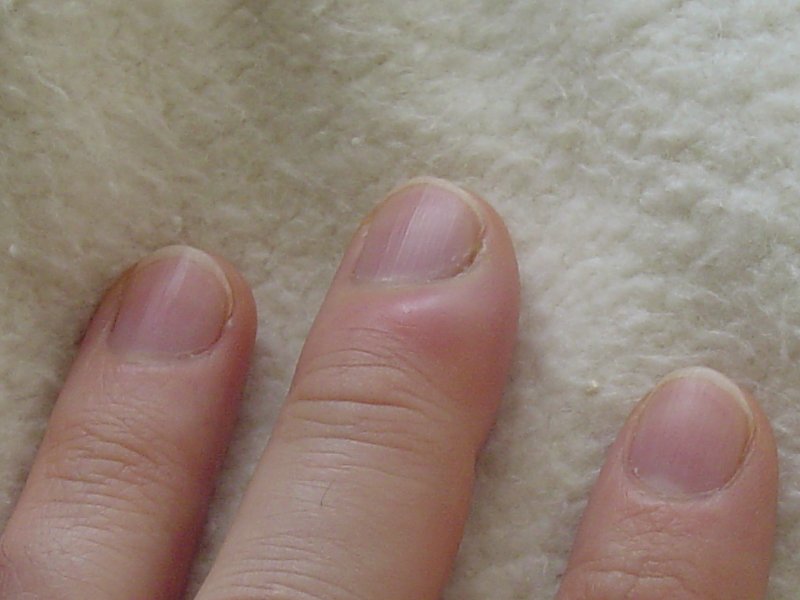 Hand iSAWE 19, clinical photograph of the fingertip