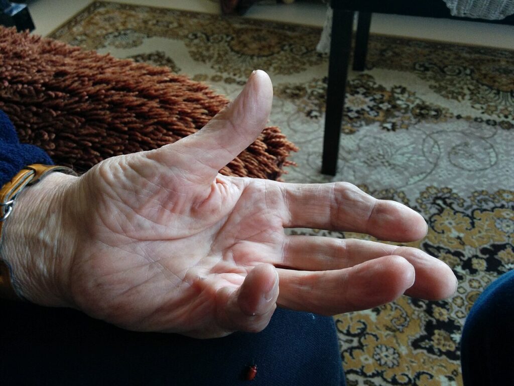 Dupuytren's Disease, dupuytren contracture
