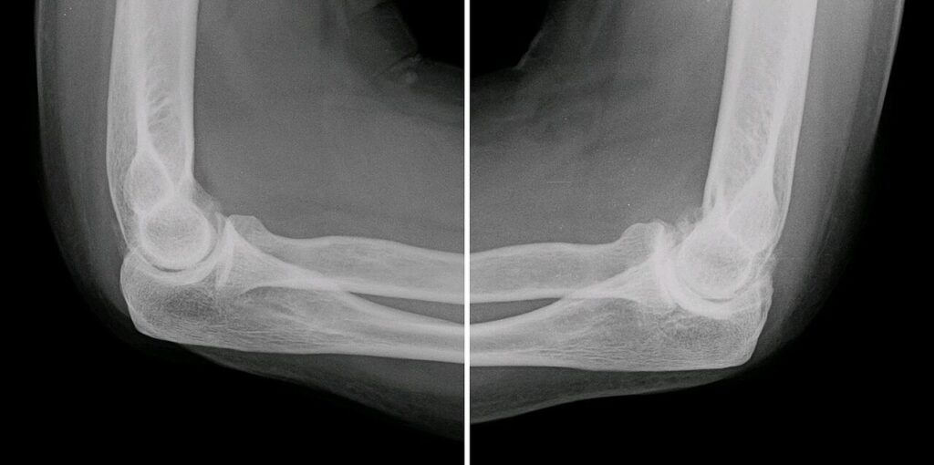 Shoulder Elbow iSAWE 20, lateral radiograph of the elbow