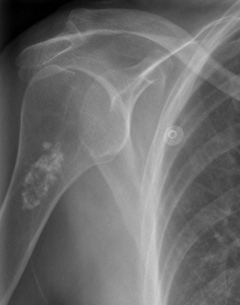 Enchondroma, radiograph of an enchondroma of the proximal humerus
