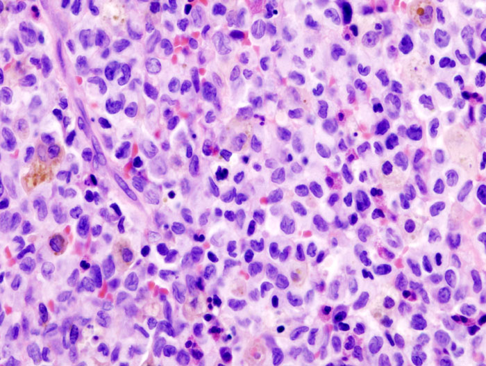 Eosinophilic Granuloma, histology of eosinophilic granuloma (langerhans cell histiocytosis)