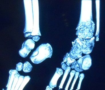 Epiphyseal Osteochondroma, imaging of dysplasia epiphysealis hemimelica (trevor disease) of the ankle