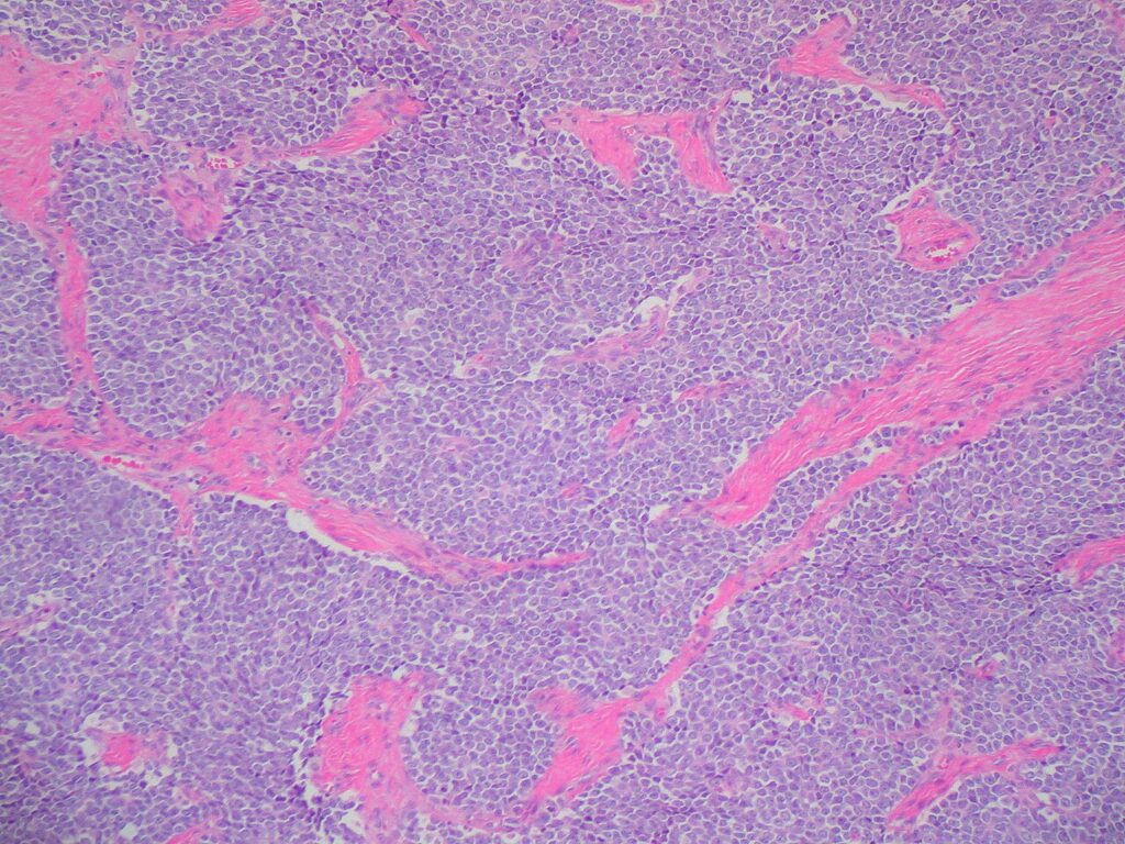 Ewing's Sarcoma, histology of ewing sarcoma