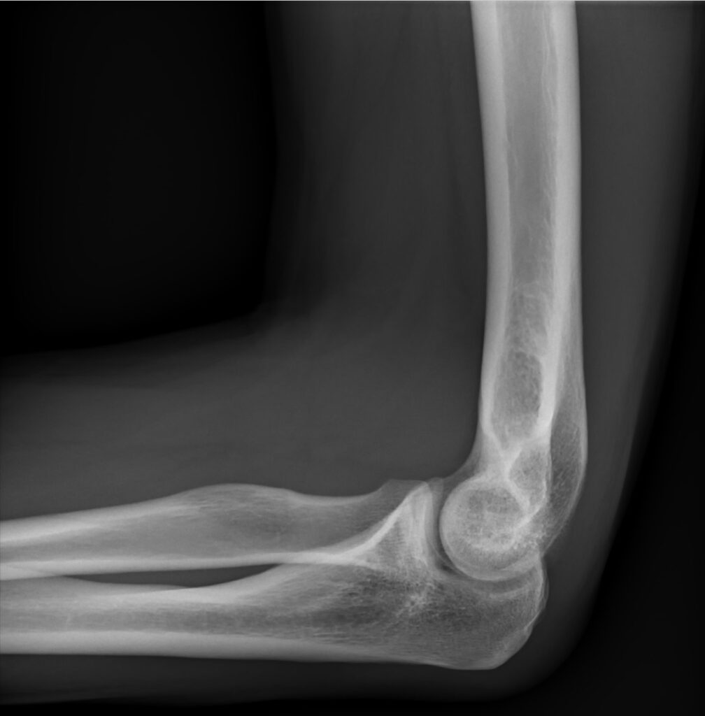 Examination of the Elbow, lateral radiograph of a normal elbow