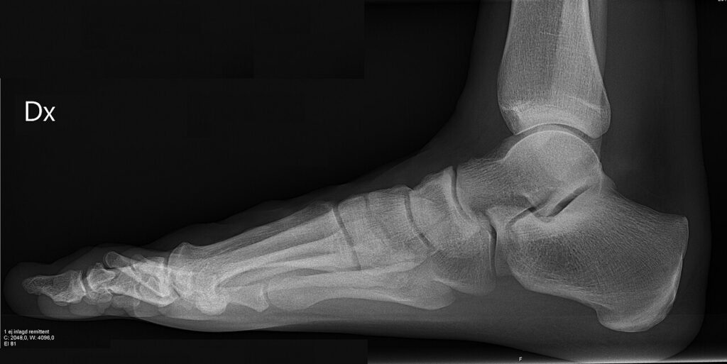 Examination of the Foot & Ankle, lateral radiograph of a normal right foot