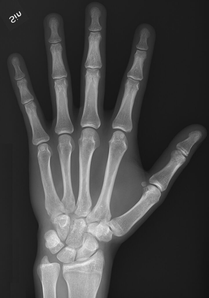 Examination of the Hand, dorsopalmar radiograph of a normal hand