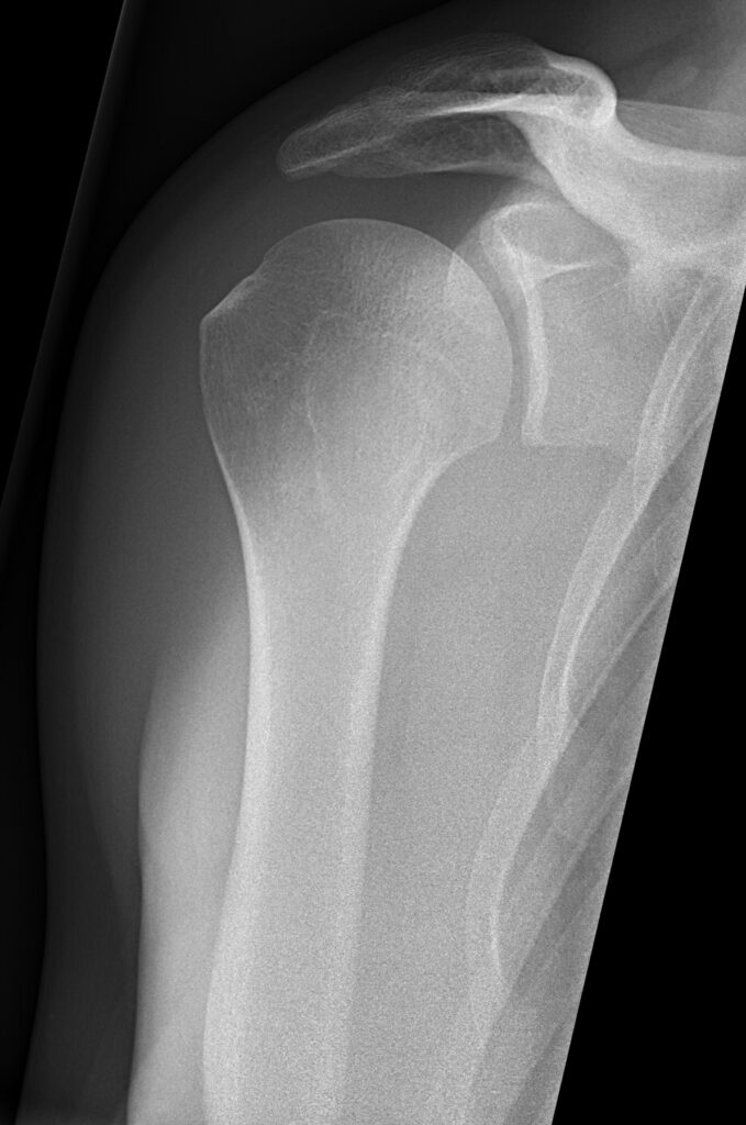 Examination of the Shoulder, grashey (true anteroposterior glenoid) radiograph of a normal shoulder