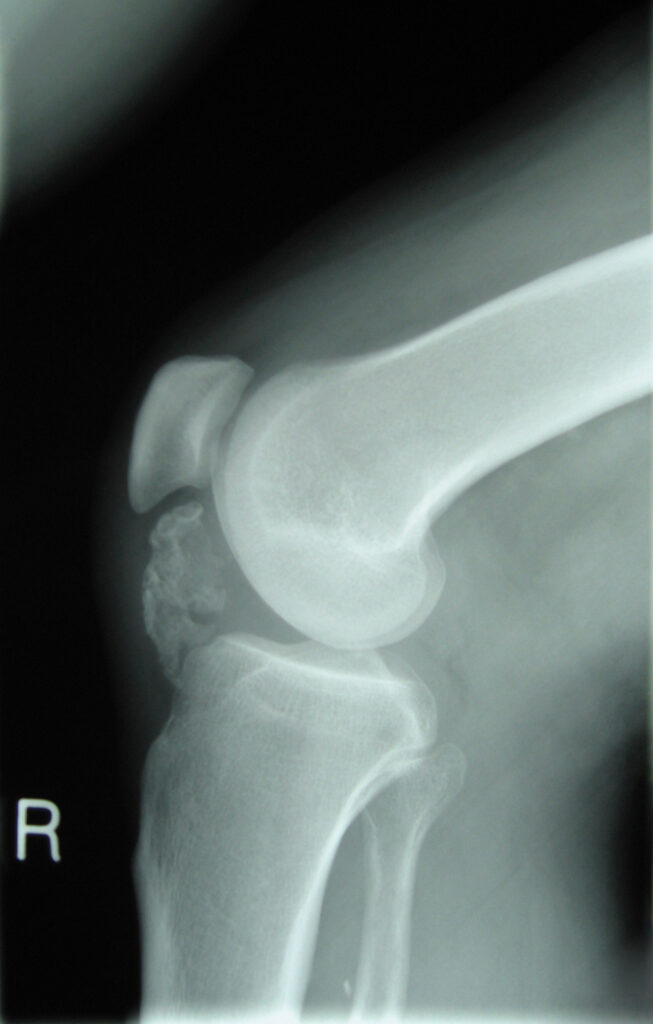 Tumour iSAWE 17, lateral radiograph of the knee