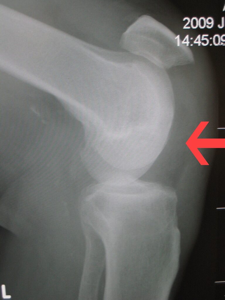 Knee iSAWE 12, lateral radiograph of the knee