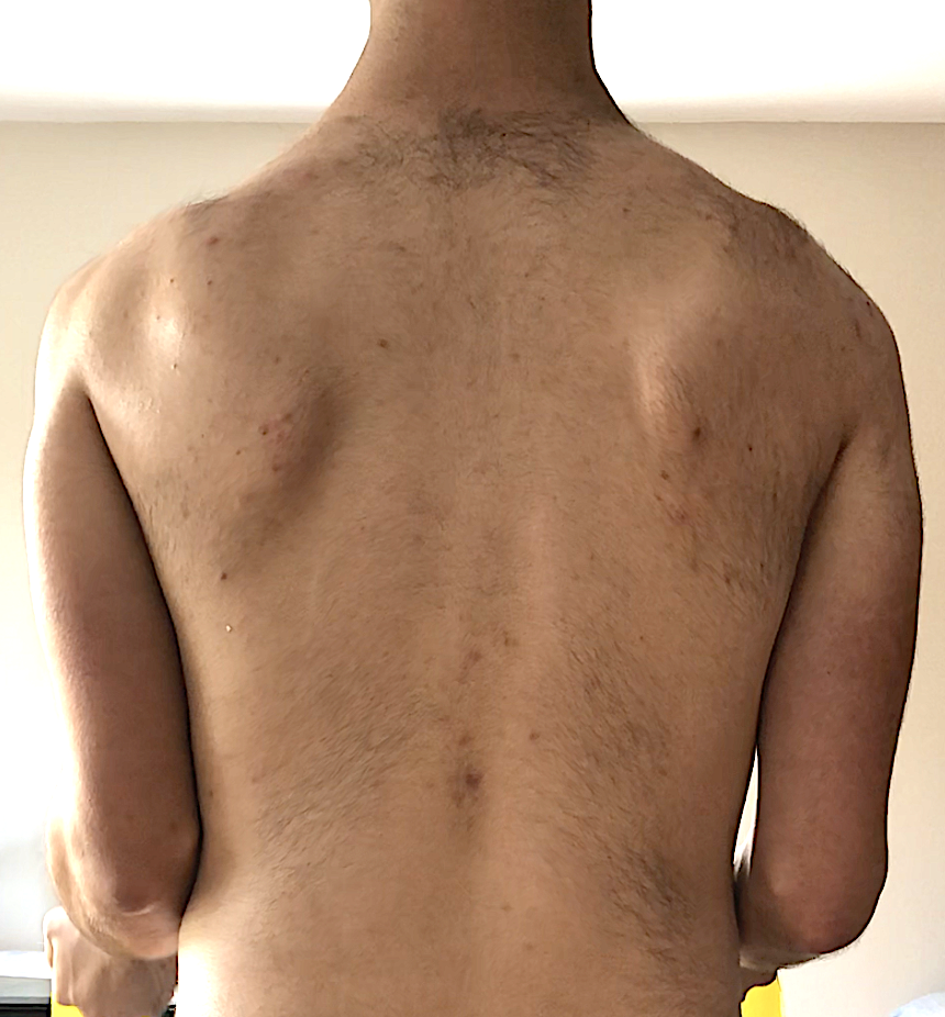 Facioscapulohumeral Muscular Dystrophy, scapular winging in facioscapulohumeral muscular dystrophy