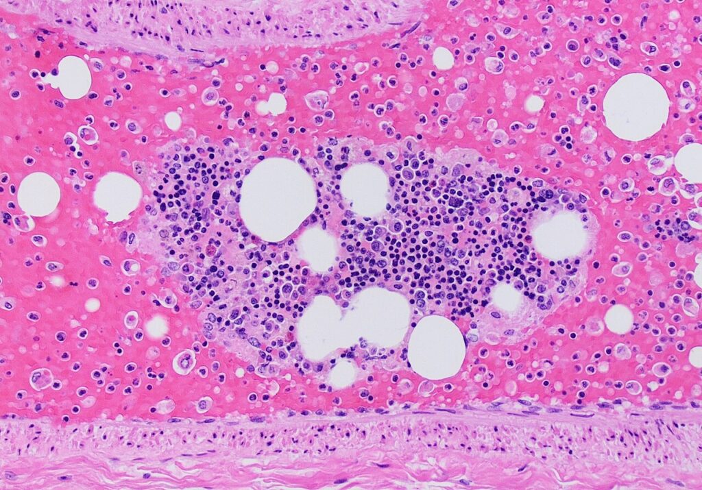 Fat Embolism Syndrome and ARDS, histopathology of a pulmonary artery containing fat emboli