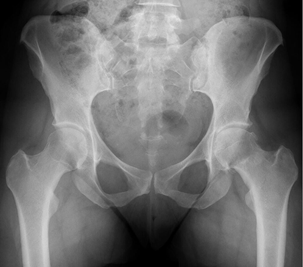 Femoroacetabular Impingement (FAI), pelvic radiograph showing cam morphology and hip osteoarthritis