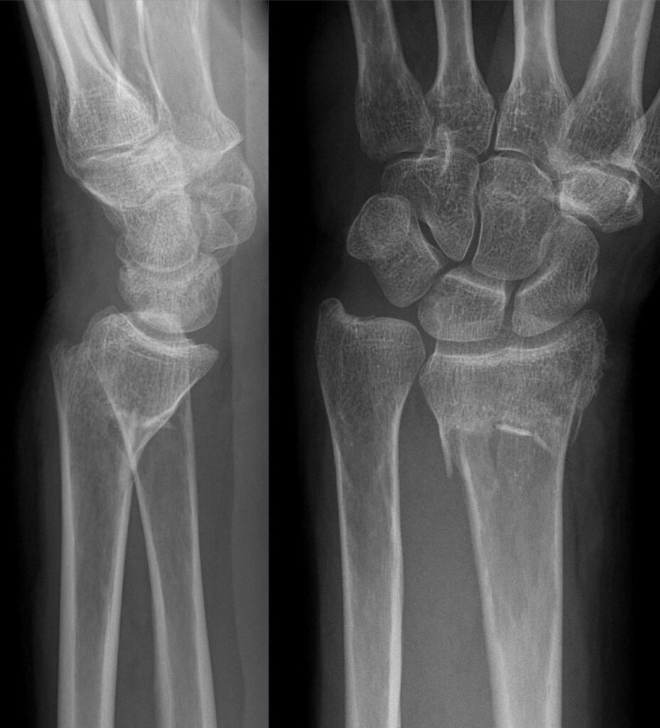 Hand iSAWE 18, lateral and PA radiographs of the wrist