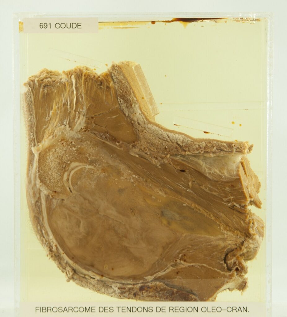 Fibrosarcoma of Bone, gross specimen of a fibrosarcoma of the elbow