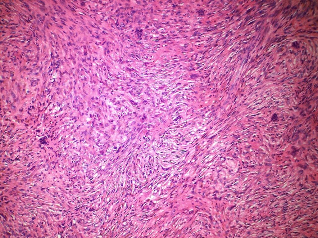 Fibrous Cortical Defect, histology of a metaphyseal fibrous defect at medium power