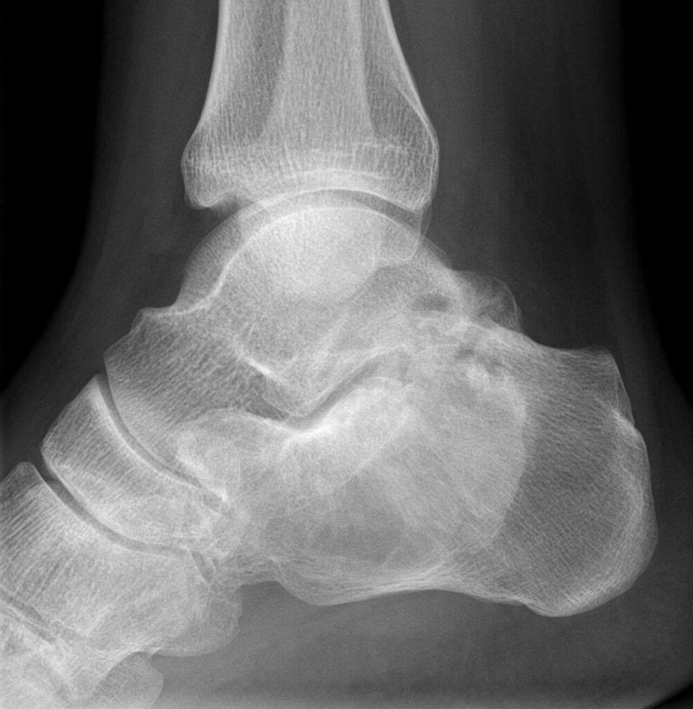 Tumour iSAWE 10, lateral radiograph of the foot