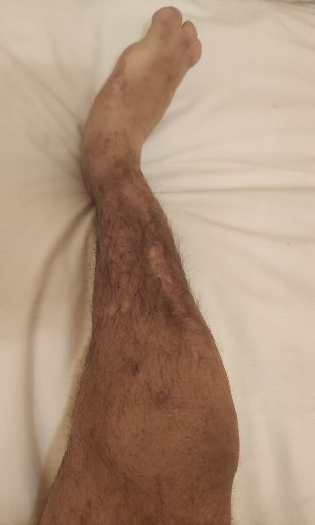 Fibular Hemimelia, clinical photograph of fibular hemimelia of the right leg