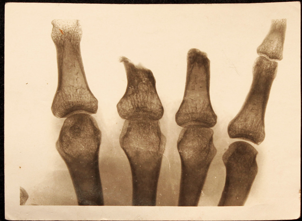 Finger/Thumb Amputations, radiograph of a hand after finger amputations, world war i era