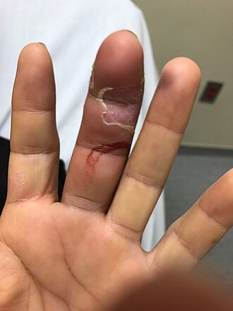 Flexor Sheath Washout, pyogenic flexor tenosynovitis
