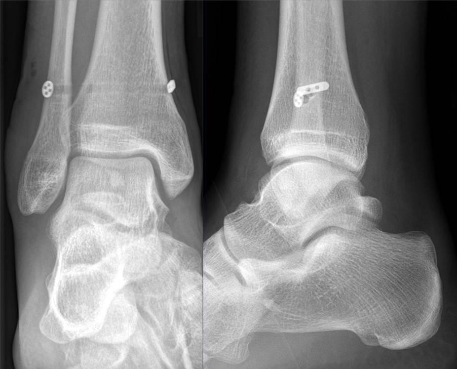 Foot Ankle iSAWE 12, AP and lateral radiographs of the ankle after fixation