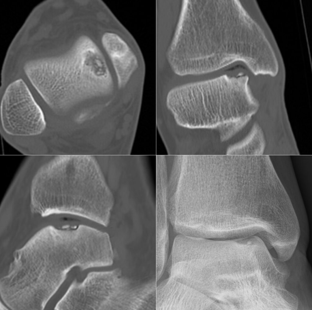 Foot Ankle iSAWE 13, CT and radiograph of the ankle