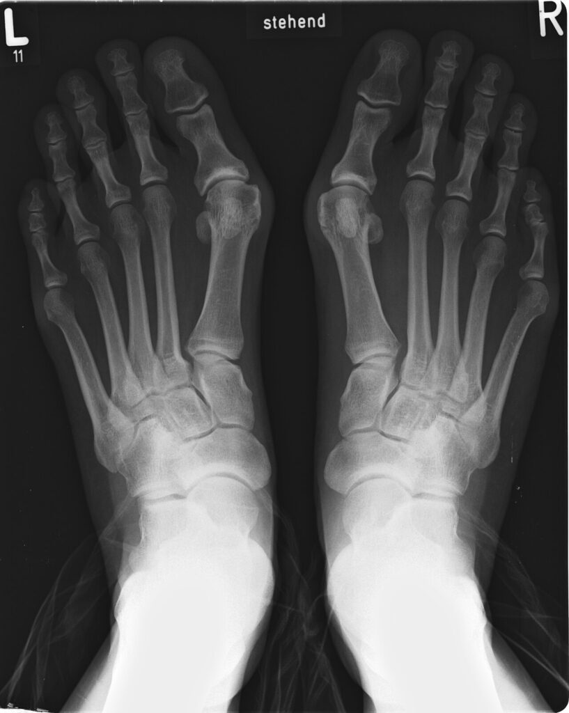 Foot Ankle iSAWE 2, standing radiographs of both feet