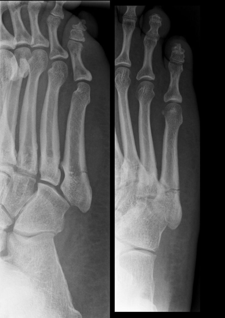 Foot Ankle iSAWE 20, radiographs of the foot