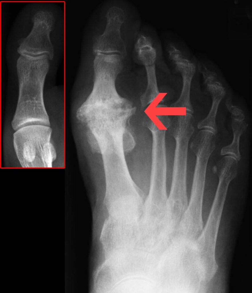 Foot Ankle iSAWE 3, radiograph of the forefoot