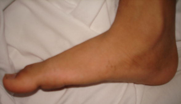 Foot Ankle iSAWE 4, clinical photograph of the foot