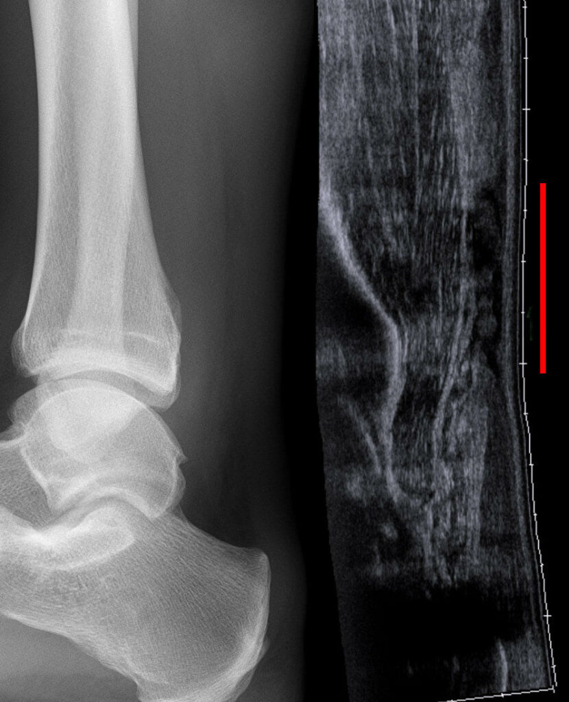 Foot Ankle iSAWE 5, lateral radiograph and ultrasound of the heel