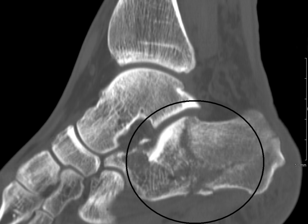 Foot Ankle iSAWE 6, sagittal ct of the hindfoot