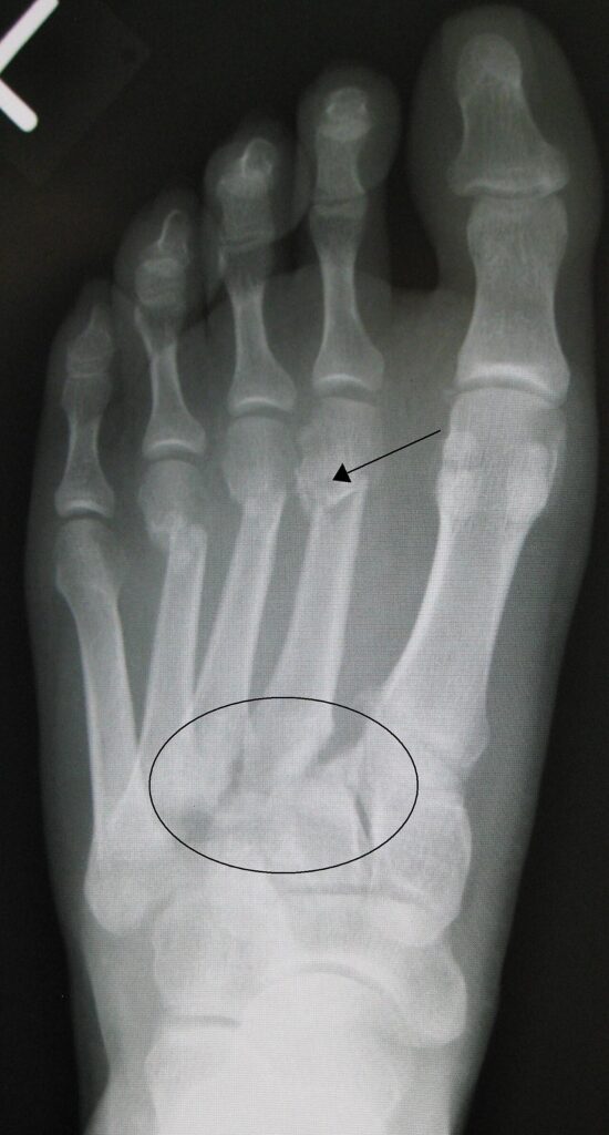 Foot Ankle iSAWE 7, ap radiograph of the foot