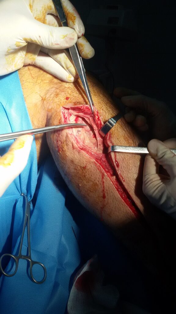 Foot Compartment Syndrome, fasciotomy for compartment syndrome