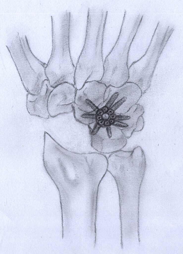 Four-corner Fusion vs Proximal Row Carpectomy, radiograph after four corner fusion