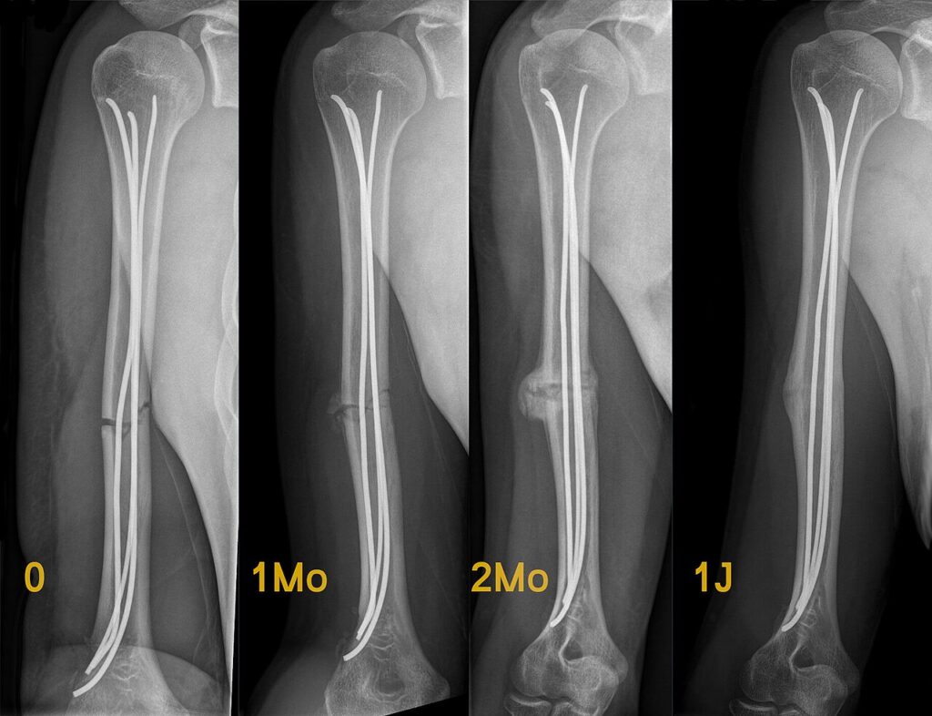 Fracture Healing, serial radiographs of a humeral shaft fracture healing with callus