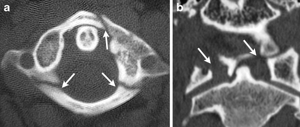 Spine iSAWE 16, axial and coronal CT of the upper cervical spine