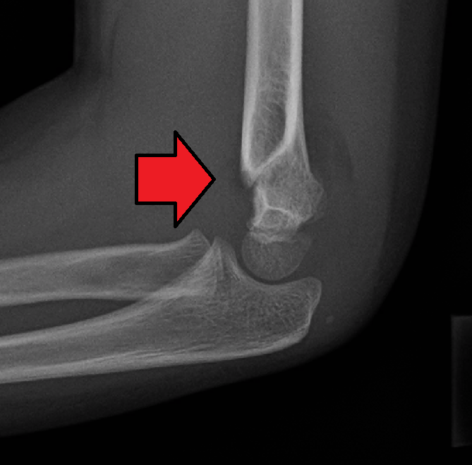 Paeds Trauma iSAWE 15, lateral radiograph of the elbow