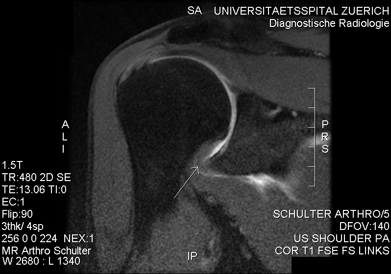 Frozen Shoulder, mri showing thickening of the inferior joint capsule in frozen shoulder