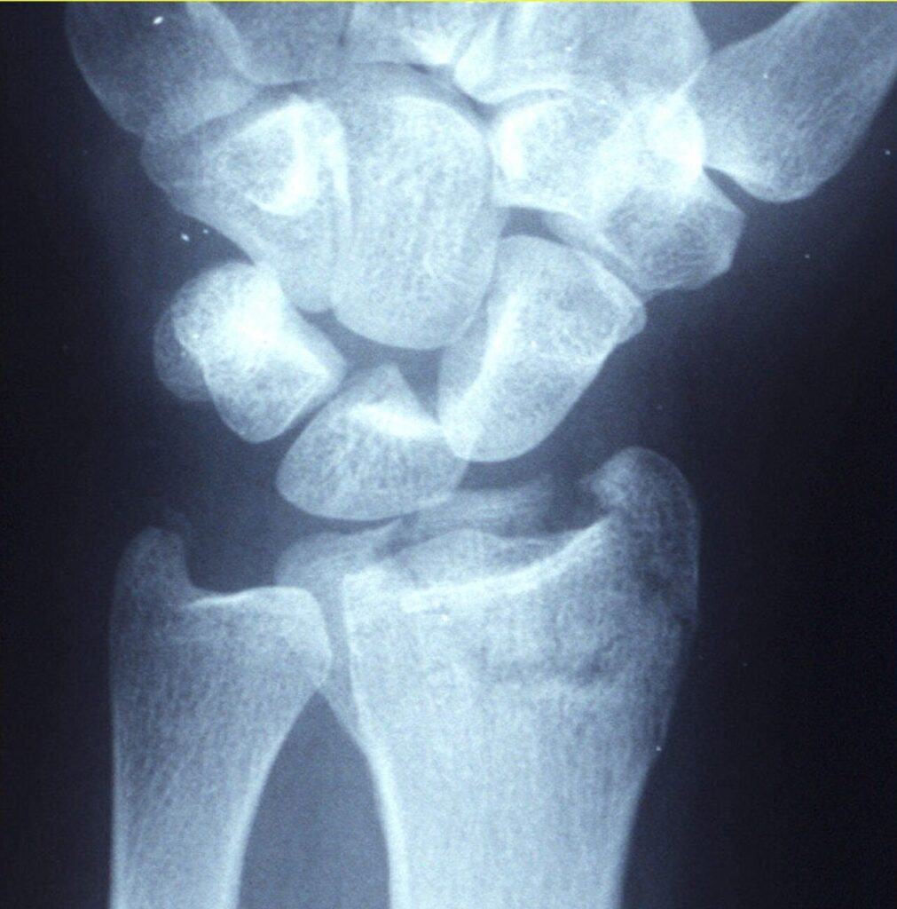 Hand iSAWE 8, radiographs of the wrist