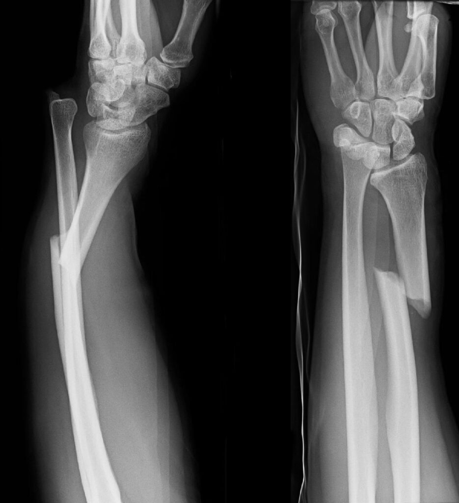 Hand iSAWE 6, radiographs of the forearm