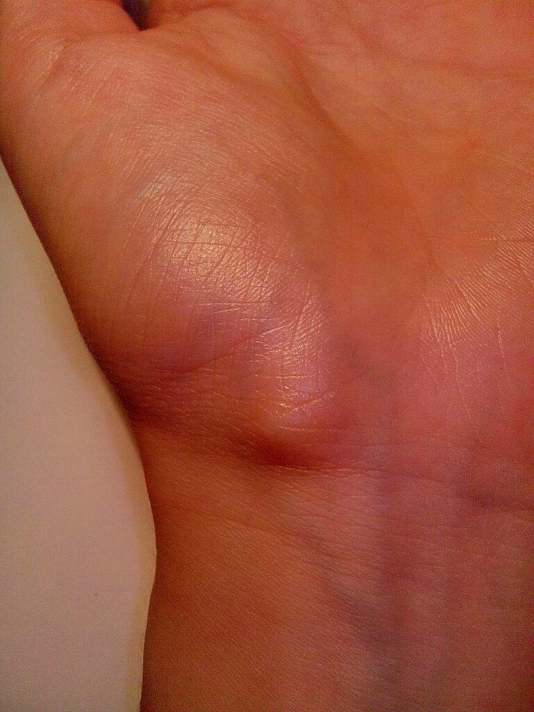 Ganglion Excision, ganglion cyst on the palmar side of the wrist