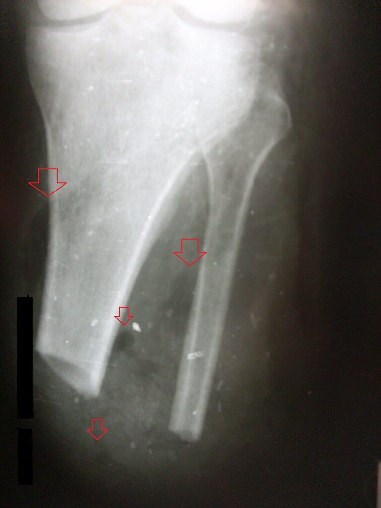 Gas Gangrene, radiograph of an amputation stump showing gas in the soft tissues from gas gangrene