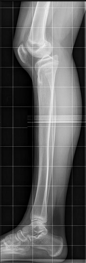 Genu Recurvatum (Congenital), lateral radiograph of genu recurvatum