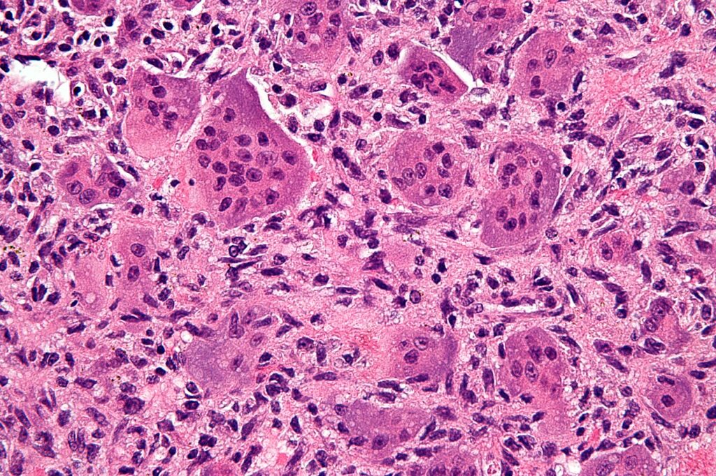 Giant Cell Tumour of Bone, histology of giant cell tumour of bone showing multinucleated giant cells