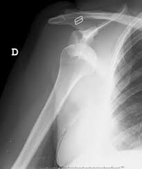 Glenohumeral Joint Acute Posterior Dislocation, radiograph of a shoulder dislocation
