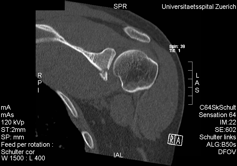 Shoulder Elbow iSAWE 17, axial CT of the shoulder