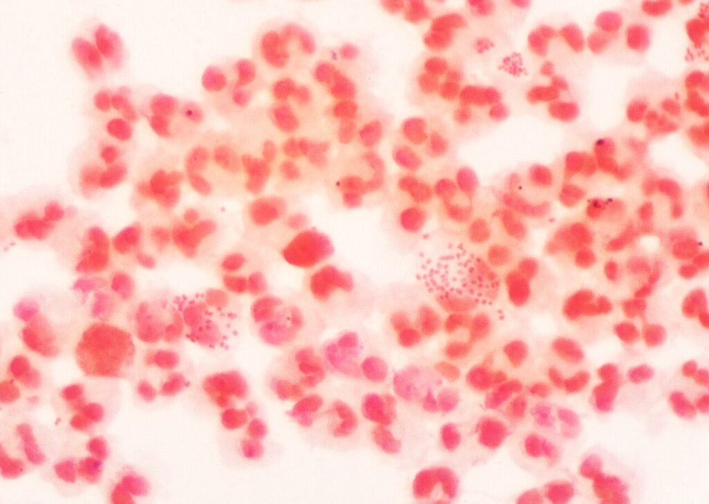 Gonococcal Arthritis, gram stain showing neisseria gonorrhoeae with pus cells